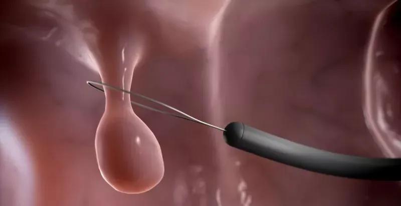 息肉时间长了会是癌吗,胃里0.2-0.4厘米的息肉要不要切