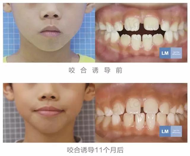 儿童牙齿早期干预矫正有几种,儿童牙齿早期矫正图片