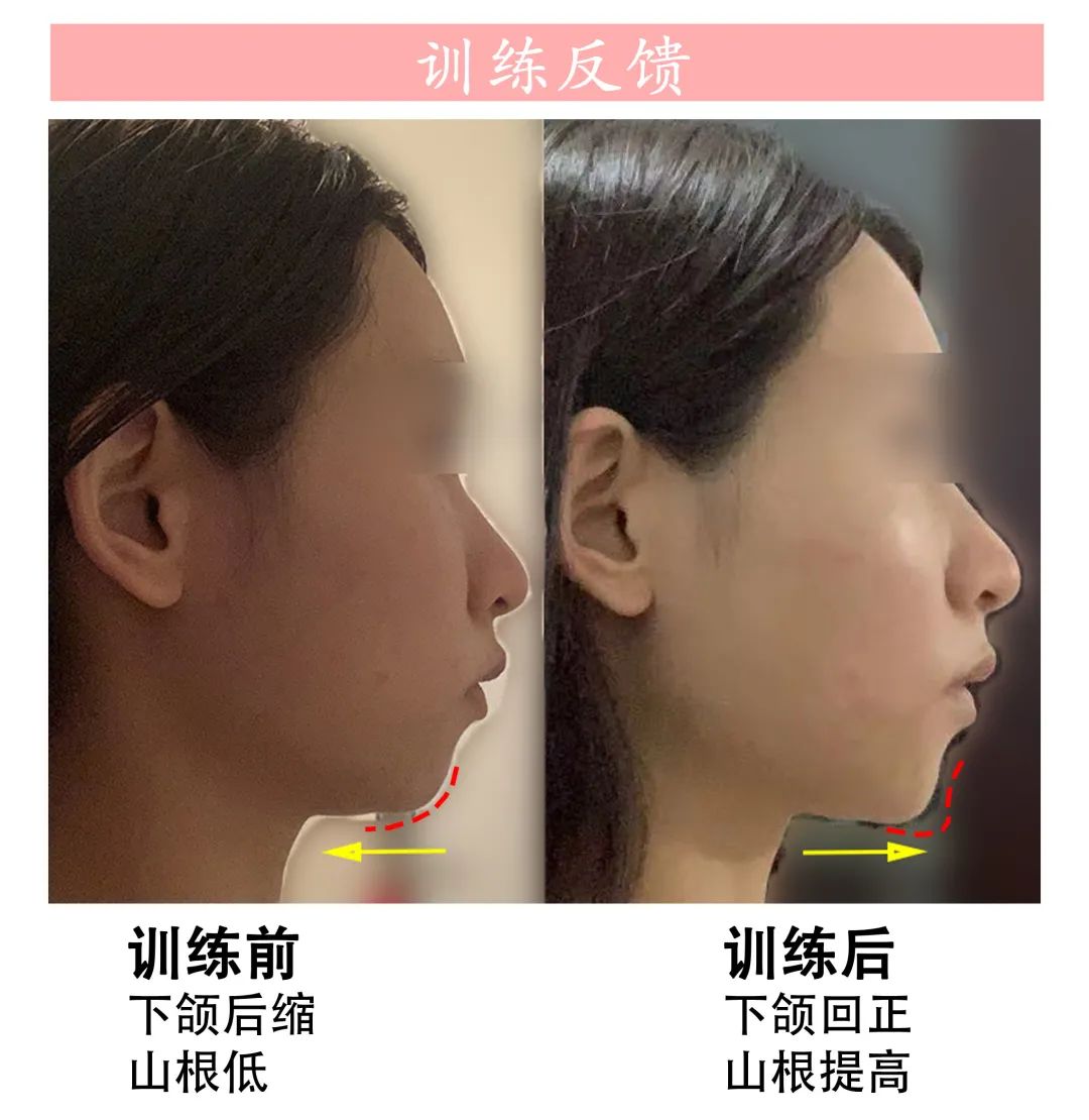 从下颚后缩到完美侧颜,侧颜杀杀手