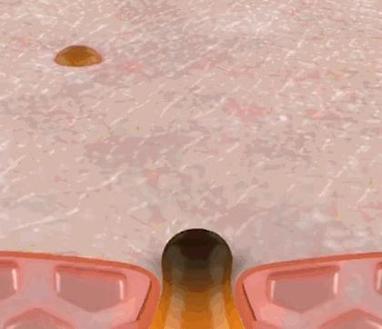 一秒去黑头去粉刺,一步就能搞定的黑头