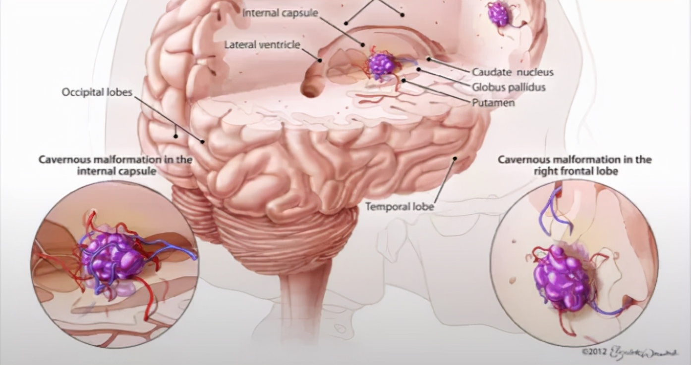 颅内海绵状血管瘤能治好吗,什么是颅内海绵状血管瘤
