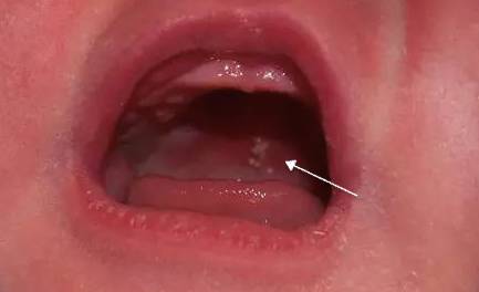 去医院怎么判断是鹅口疮还是马牙,新生儿马牙和鹅口疮的区别