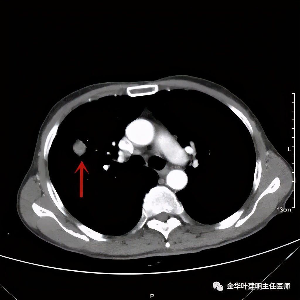 左肺占位被安排穿刺活检是肺癌吗,肺癌肺部穿刺有什么危险