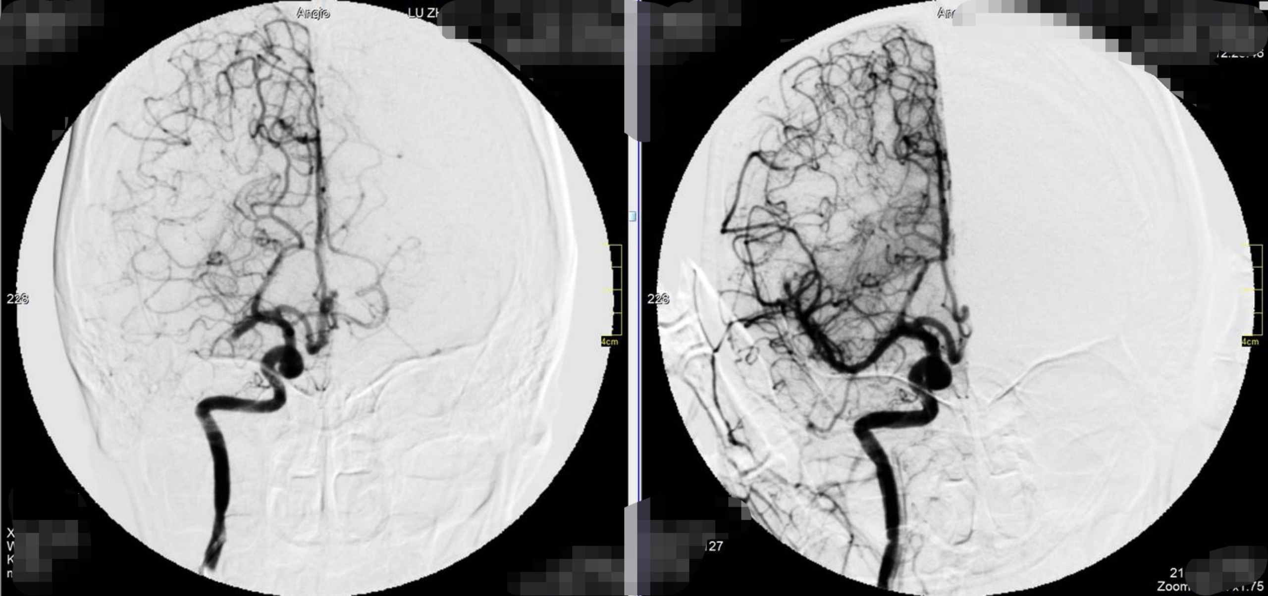 如果脑血管有血栓怎么治疗最好,老人脑血管堵塞最快消除方法