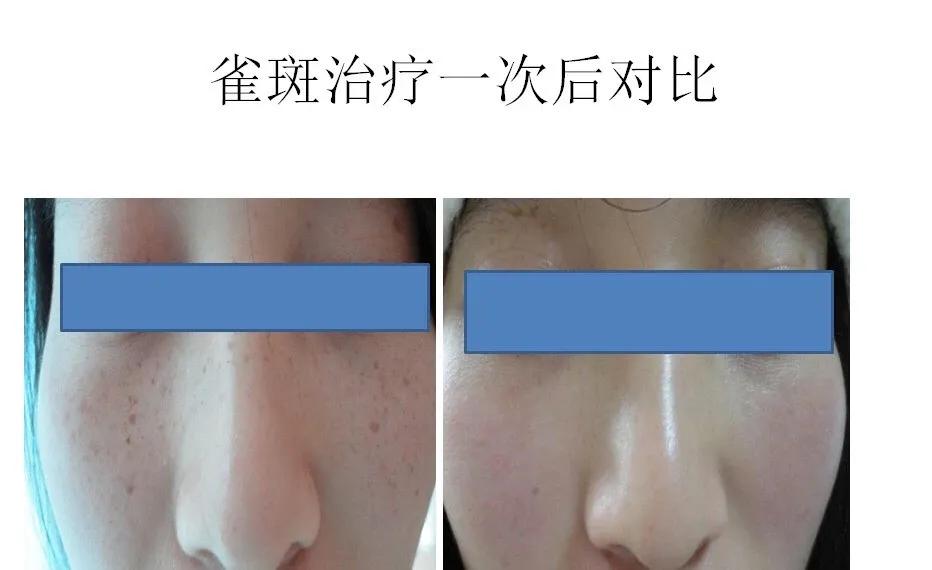 微微之光，让我记住你的美——陕西省皮防所医院超皮秒、热玛吉媒体专场活动圆满结束