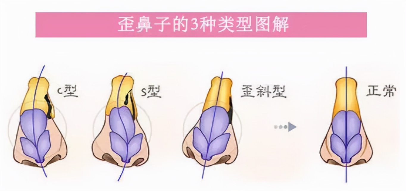 唇裂鼻畸形的最佳修复时间,唇裂科普视频