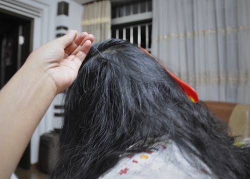 少年白发怎么治疗最快,少年白发怎么治理