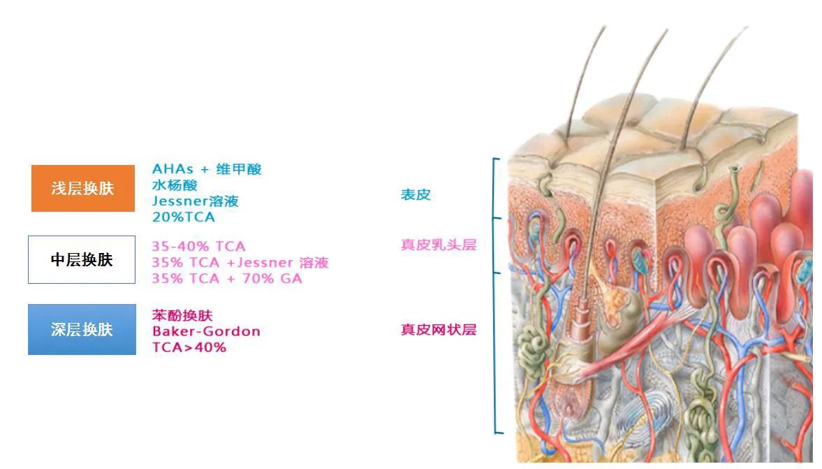 化学换肤术是什么意思,化学换肤术又叫什么