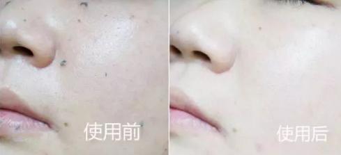 吸黑头神器去粉刺角质收缩毛孔,皮肤清洁收缩毛孔黑头角质