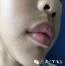 起白斑是什么原因,起白斑就是白癜风吗