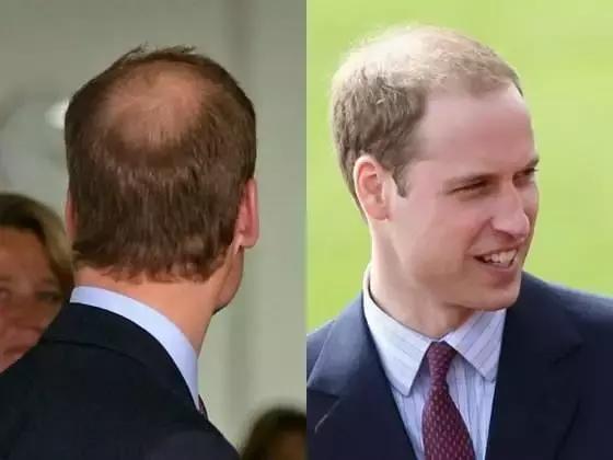 小孩喝完浑身长毛的这种“神药”,脱发的90后可否来一瓶?