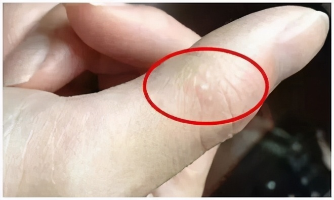 手上长了好多小水泡可以挤吗,手上长小水泡一挤就流水是什么病