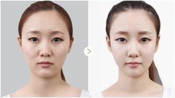 光子嫩肤操作视频,光子嫩肤全身价格