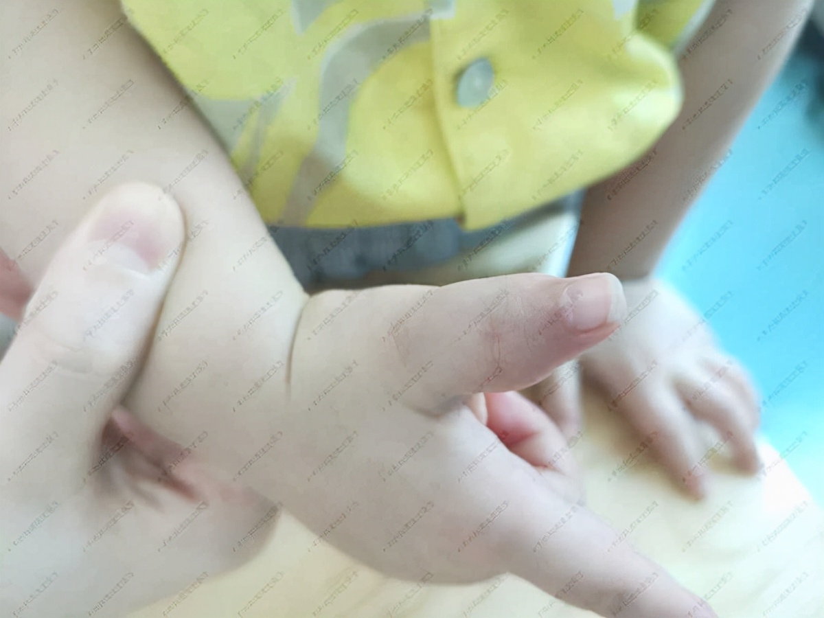 手多指同时脚也多指的婴幼儿多吗,婴儿多指并指多大手术最好