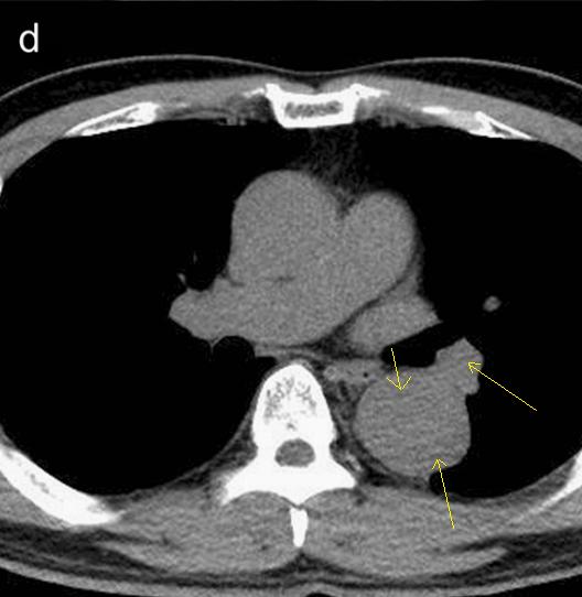 肠系膜上动脉夹层,心脏动脉夹层破裂