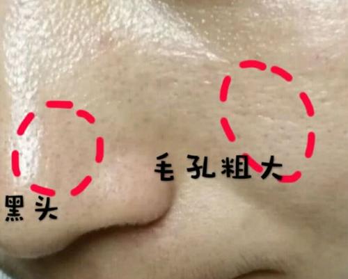 痘印痘坑黑头毛孔粗大整形,毛孔粗大整形医院能弄好吗