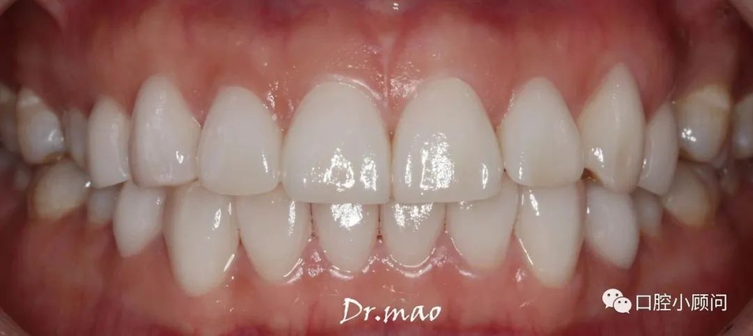 鎬庝箞缇庣櫧鐗欓娇,鐗欓娇璐寸墖缇庣櫧