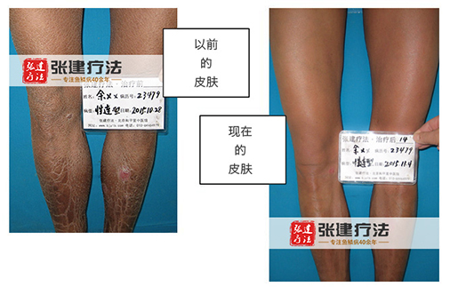 医学那么发达为什么不能根治脱发,现在中国有治鱼鳞病的吗