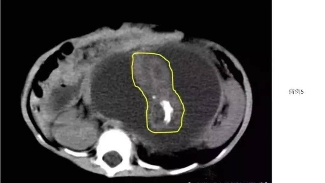 卵巢原发肿瘤的分析思路