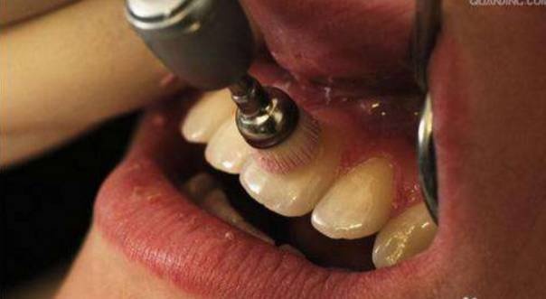 洗牙的过程是怎样的？洗牙有哪些注意事项呢？