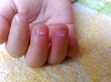 小孩锌缺了是啥症状,孩子锌元素摄入不足的表现