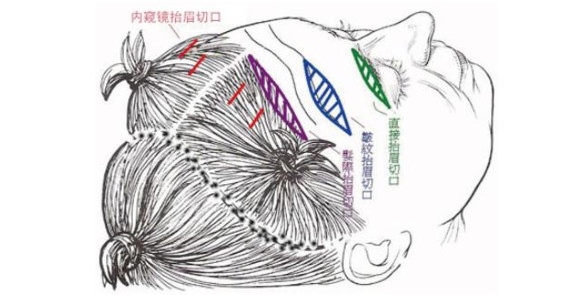 抗衰老术,脸部抗衰老手术方法