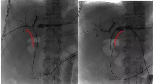 胆管下段良性肿瘤手术治疗方法,恶性肿瘤小肠梗阻介入治疗