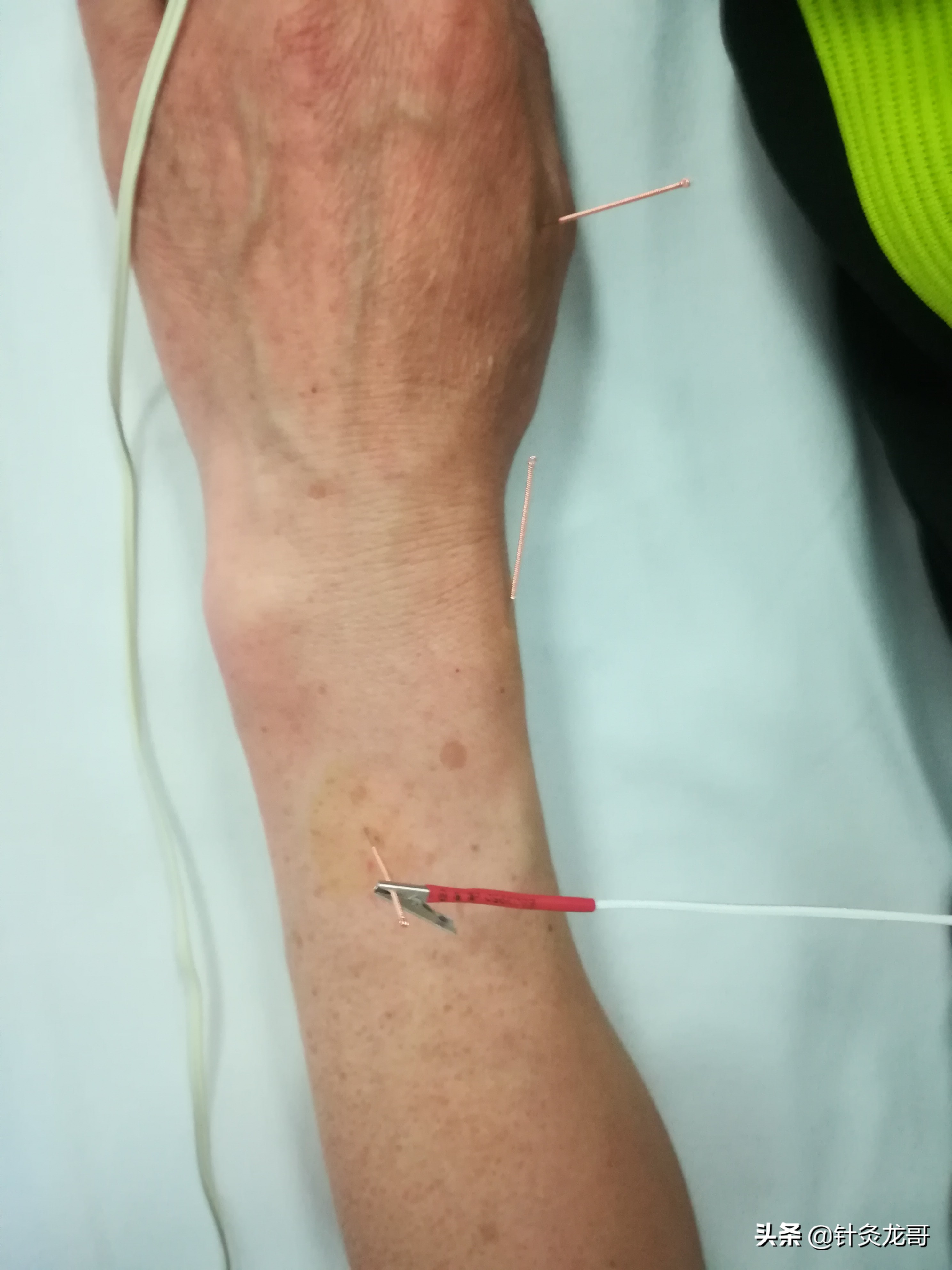 咽喉有异物怎么检查一下,咽喉有异物感好几个月了