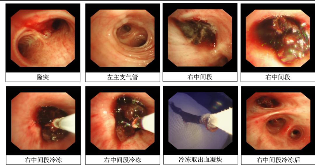 「梦里与丈夫吵架」醒来后咯血，是什么导致了她右侧支气管阻塞？