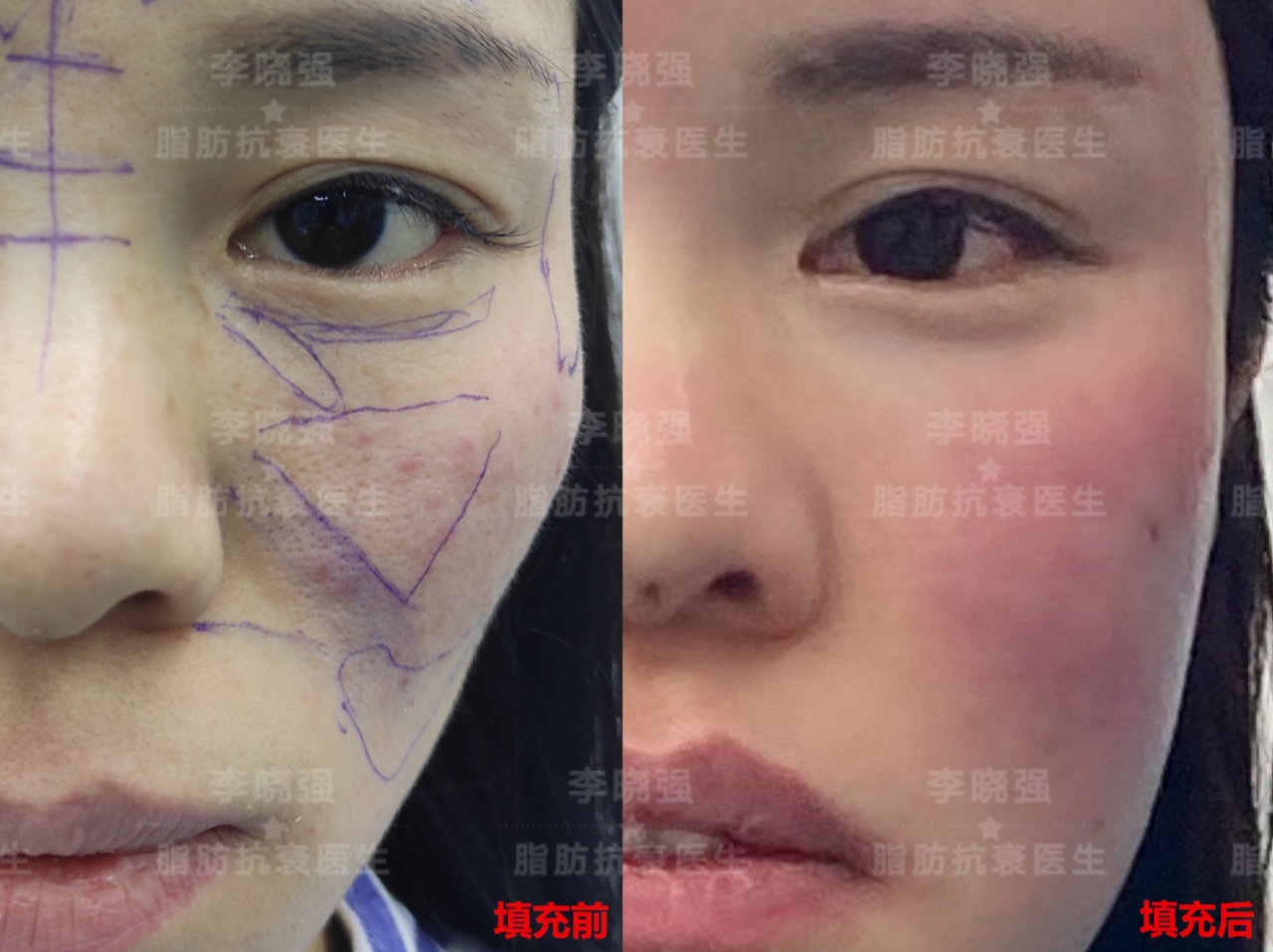 面部精雕收颧骨手法,颧骨高太阳穴凹陷怎么整形