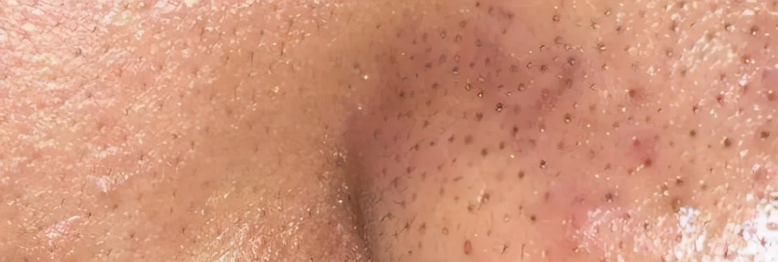 如何根据不同肤质挑选护肤品呢,角质层薄混合肤质用什么护肤品