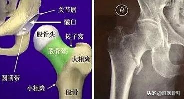 老年人骨折最怕什么病,老年人最常见的骨折有哪些