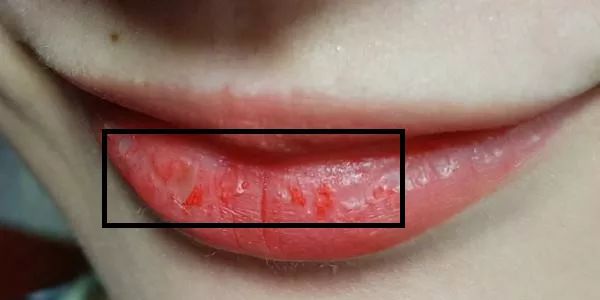 嘴唇不再干燥起皮温和润唇,秋冬唇干燥起皮