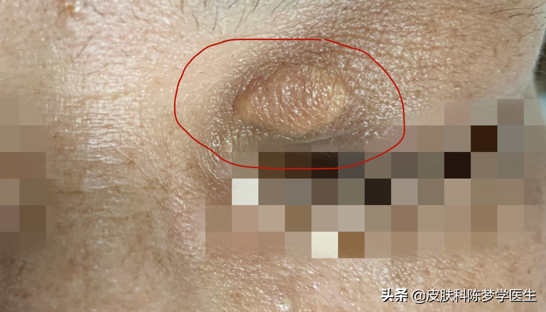 脖子上长了几个针尖大的肉球,脖子上长了丝状疣是感染了hpv吗