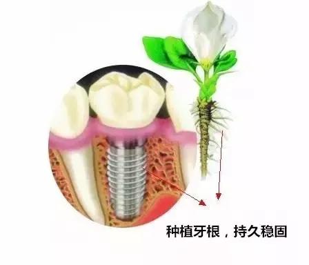 种植牙种植失败可以要求退款吗,种植牙失败了哪里投诉