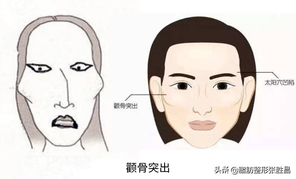 颧骨突出显凶怎么改善,脸凹显凶