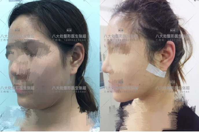 八大处整形张超,八大处张超最新视频