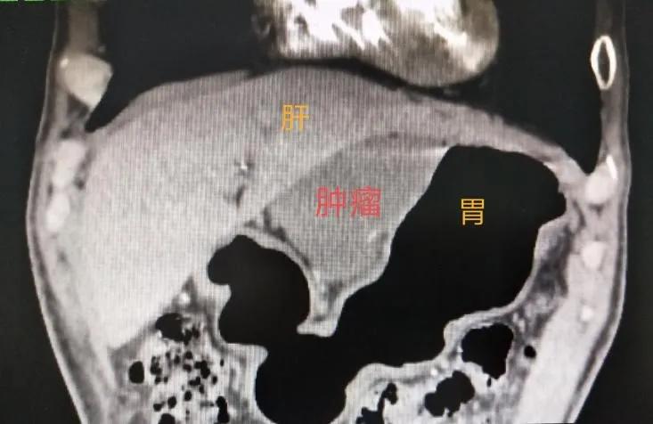 胃肠间质瘤典型病例诊治与解析,桂林医学院附属医院肠胃科