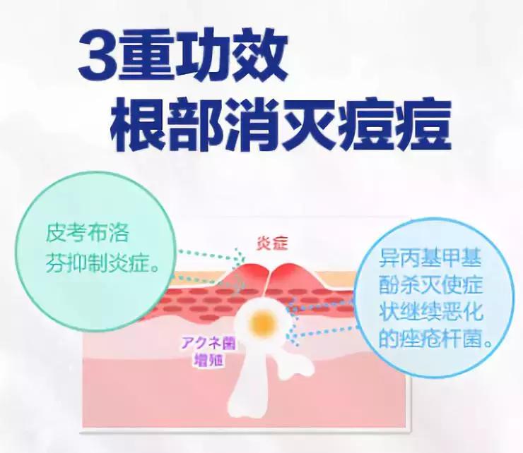 狮王祛痘膏和过氧苯甲酰凝胶,日本狮王祛痘膏可以长期使用吗