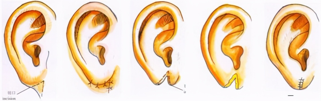耳垂裂开修复哪里可以做,耳垂裂到哪个科室去修复