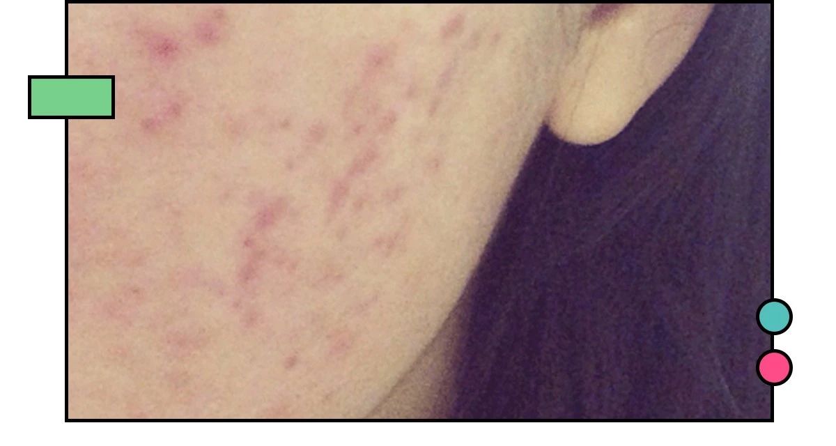 如何祛痘印?看了这篇能解决你大部分的问题!