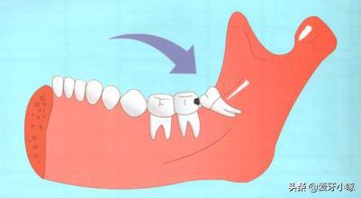 智齿经常疼痛到底要不要拔掉,智齿反复疼痛到底要不要拔掉