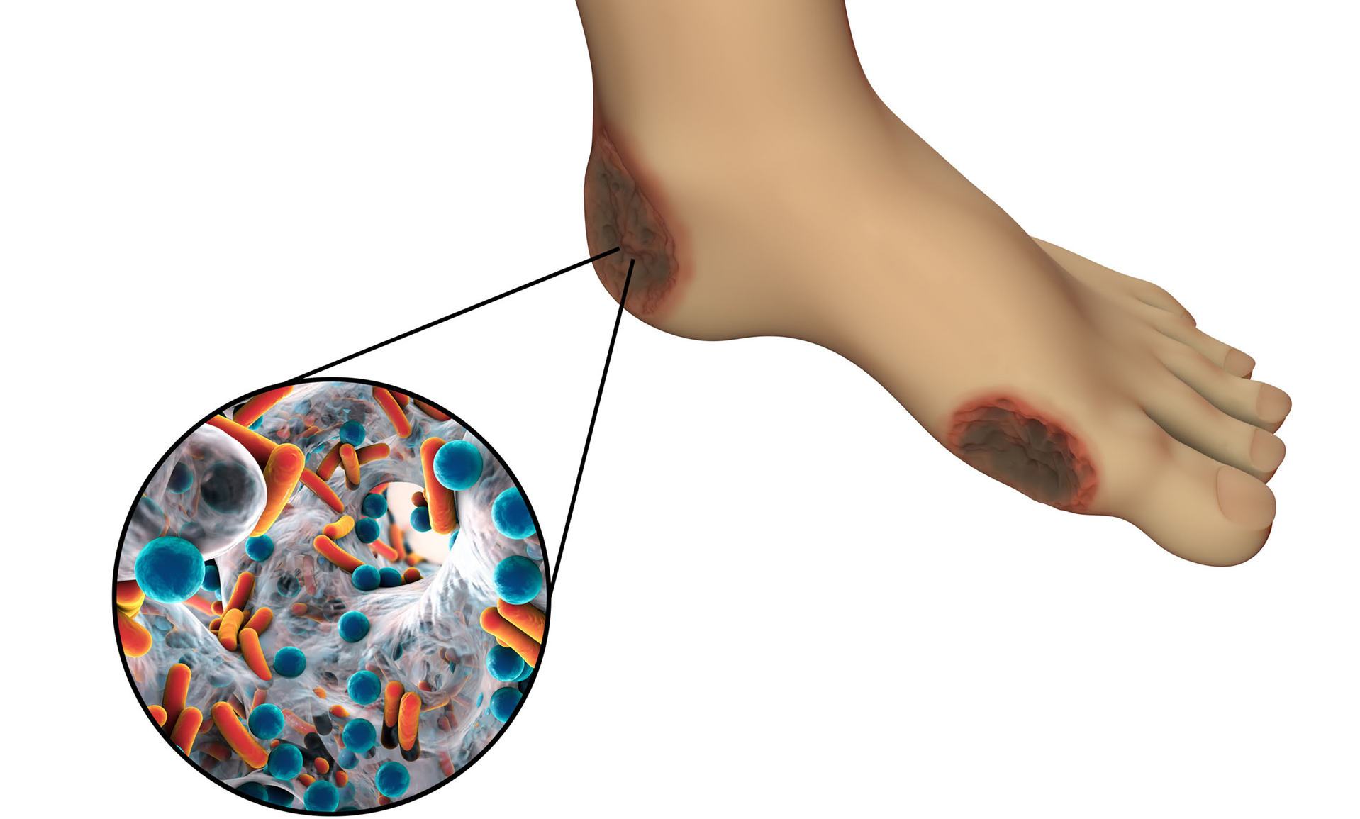 只是泡脚烫伤，却要截掉两根脚趾！糖尿病足，为什么这么可怕？