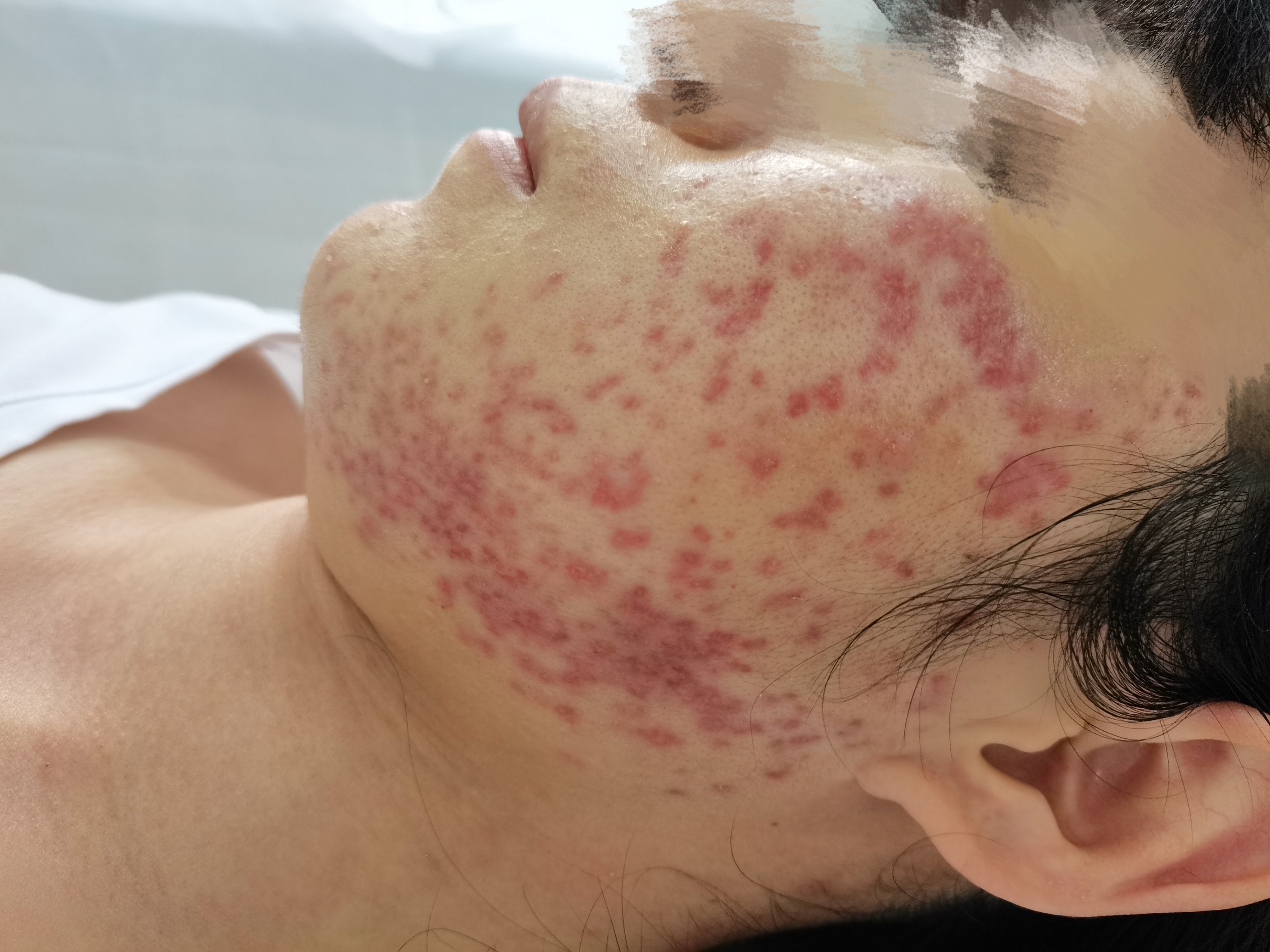 得了痤疮不能吃什么,得痤疮有必要吃异维a酸软胶囊吗