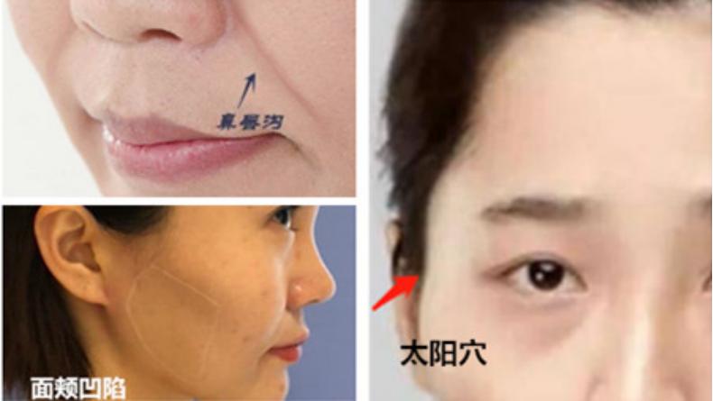 脸颊凹陷医美怎么改善,十全九美