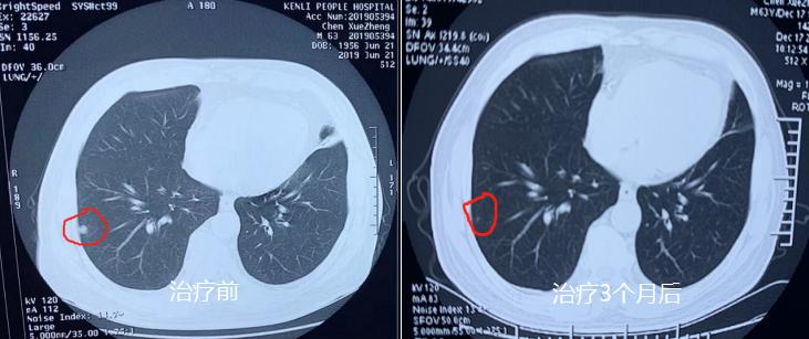 双肺多发微小结节最大的5mm严重吗,双肺多发微结节3-4mm用吃药治疗吗