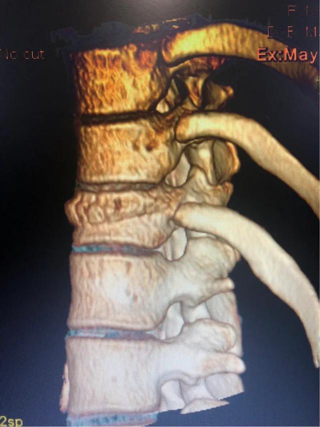 摔跤了坐起来腰部很疼是什么原因,摔跤腰扭伤阴天疼痛后遗症