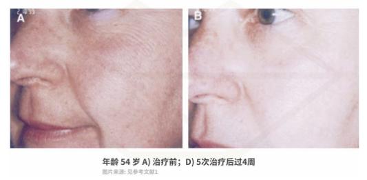 毛孔粗大缩毛孔最有效的方法,脸上毛孔粗大出油快速缩毛孔