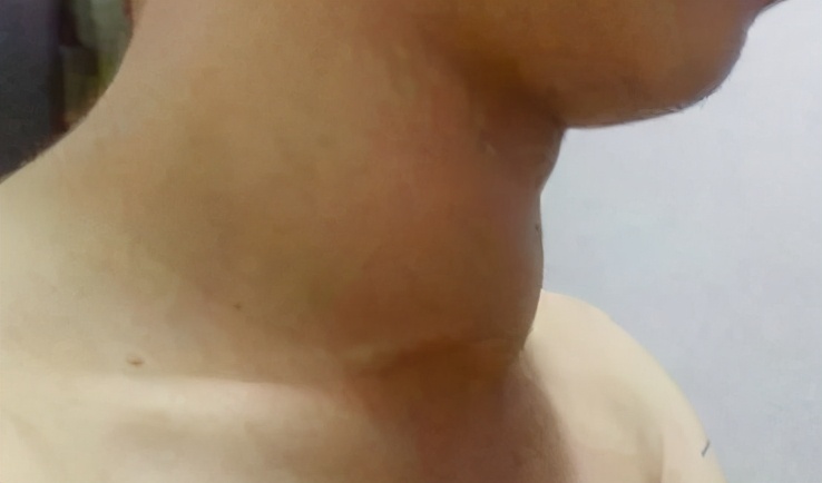 全国甲状腺知识宣传周,国际甲状腺知识宣传周央视