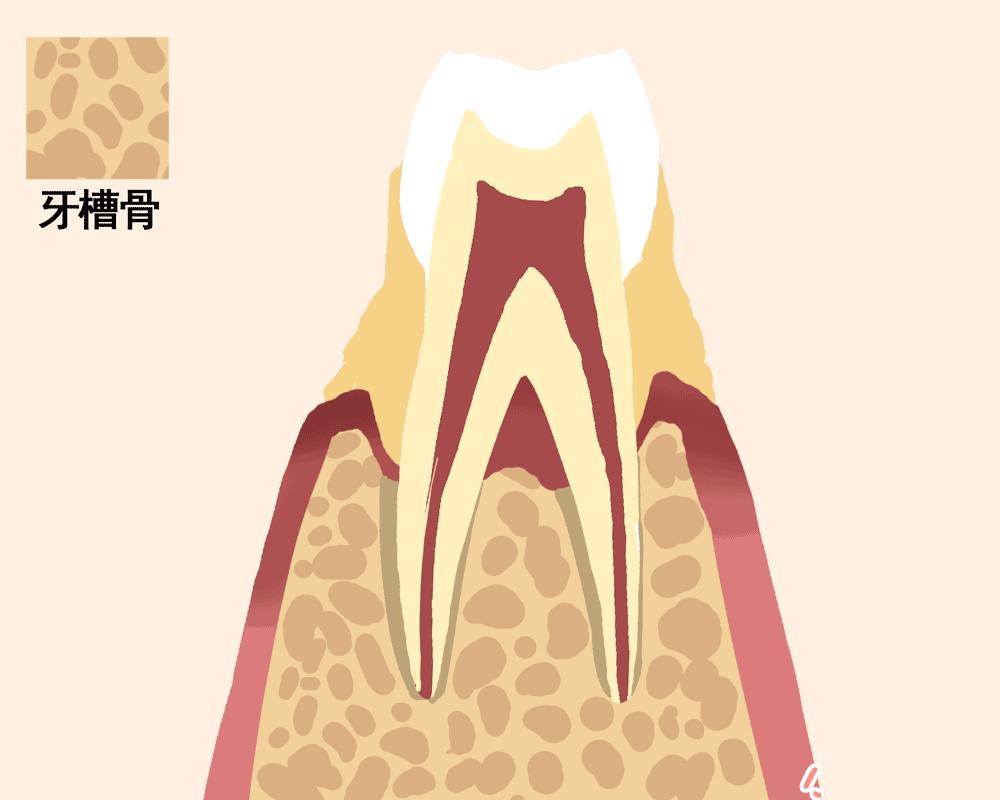 牙槽骨吸收严重怎么办？为什么会出现牙槽骨吸收？